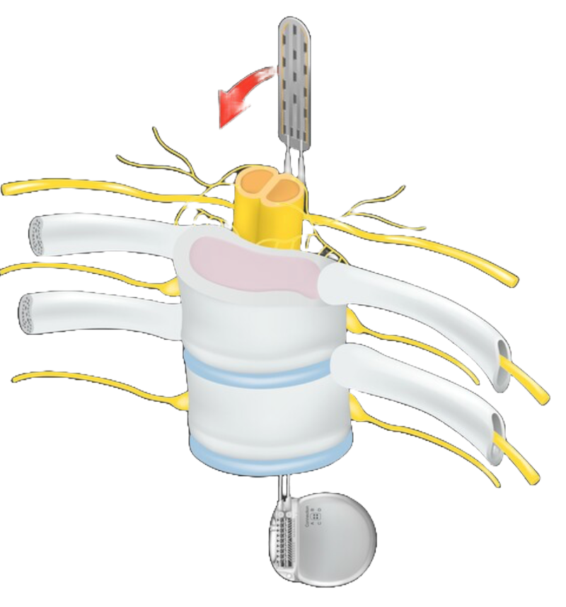 Spinal Cord - IMES Sensor